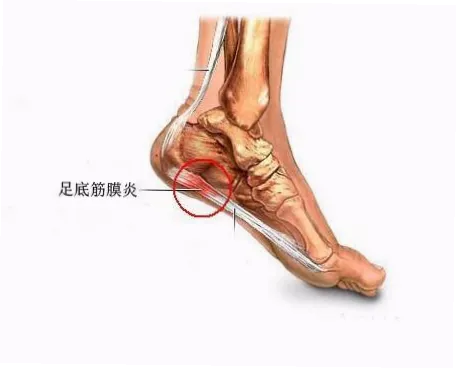 为什么运动反而会让韧带更松弛？